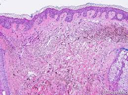 Image result for Blue Nevus
