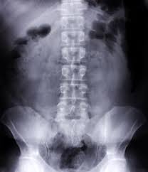 What Are The Dangers Of An Inversion Table Livestrong Com Inversion Table Inversions Inversion Therapy