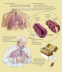 Image result for Acute Bronchitis