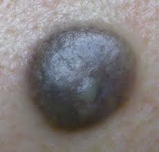 Image result for nevus sclerae