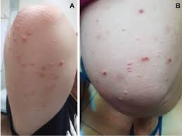 However, the growth can be removed with surgery or chemical treatments. Diabetic Dyslipidemia With Eruptive Xanthoma Cleveland Clinic Journal Of Medicine