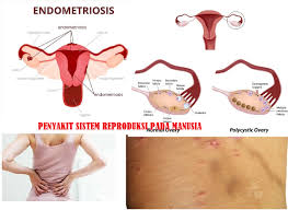 Maag merupakan penyakit atau gangguan sistem pencernaan yang ditandai dengan adanya rasa perih pada dinding lambung, selain itu maag juga disertai dengan adanya rasa mual dan perut menjadi kembung. Penyakit Pada Sistem Reproduksi Manusia Dan Upaya Pencegahannya Dengan