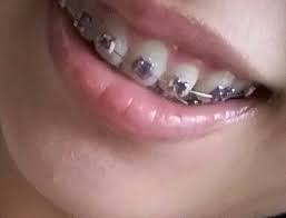 Dark Violet And Light Pink Braces Light Pink Color Pink