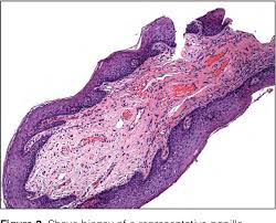 Importance Of Dermoscopy To Diagnose Vulvar Vestibular Papillomatosis Vs.  Warts | Semantic Scholar