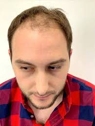 Tijuana Hair Transplant Reviews and Testimonials