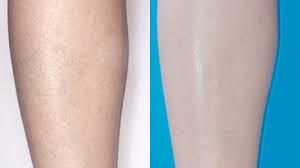 Permanent hair removal creams such as hair free no. Hair Removal Vein And Laser Institute
