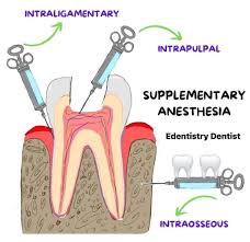 Image result for Intrapleural Anesthesia