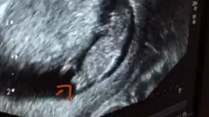 Kann man an der form des babybauchs erkennen, ob es ein junge oder mädchen wird? Was Meint Ihr Madchen Oder Junge Habe Zwei Deutlich Weisse Striche Gesehen Schwangerschaft Geschlecht