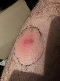 But when it enters the skin — through a. Staph Album On Imgur