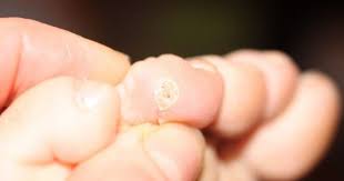 Natural Wart Remedies One That Really Works Wart Treatment Warts Remedy Warts