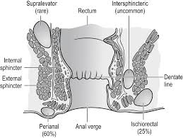 Image result for Perirectal Abscess