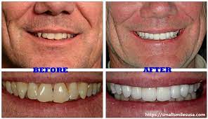 The website does not give statistics for the number of participants that have dental insurance coverage exclusively. How Much Do Dental Veneers Cost Small Smiles Usa
