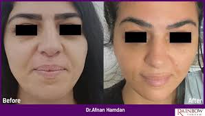 Threads for face lifting and contouring of jaw line. Dr Afnan Hamdan  Dermatologist, aesthetic and laser specialist. Sarasaudi center /abdun  0799756793 شد الوجه و تحديده من خلال الخيوط. الدكتوره أفنان حمدان أخصائيه