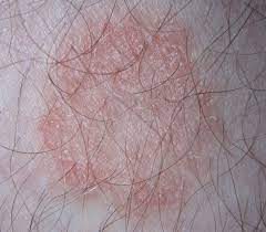 Hautpilz Infektionswege Online Diagnose Therapie Durch Hautarzte