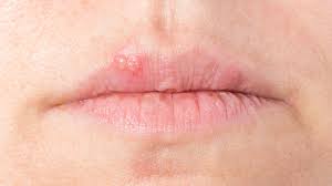 Eur 2,49 bis eur 8,99. Herpes An Lippen Oder Nase Richtig Behandeln Ndr De Ratgeber Gesundheit
