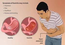 Rationale in diagnosis and screening of atrophic gastritis with. Gastritis Radang Lapisan Lambung Gejala Kronis Penyebab Obat