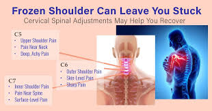 The shoulder is unstable because the joint does not keep the bones close together. Frozen Advanced Medical Pain Rehabilitation Center Facebook