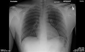 We did not find results for: Lordotic View Cxr Shefalitayal