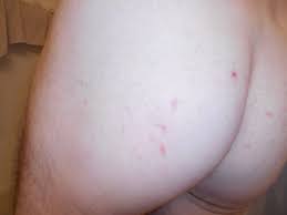 This is so because the area is exposed to plenty of bacteria. Red Bumps Persist Butt And Back Pictures Attached Genital Herpes Simplex Forums Patient