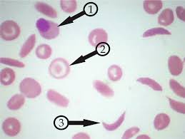 Show declension of target cell. 1 Nucleated Red Cell 2 Target Cell And 3 Irreversibly Sickled Download Scientific Diagram