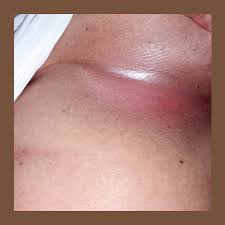 Image result for Candidiasis under breasts