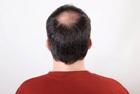 Introduction — hair loss is a common clinical complaint that is a manifestation of a wide variety of disorders. Smokers Are More Likely To Have Androgenetic Alopecia Despite Negative Family History Dermatology Advisor