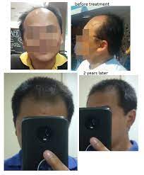 Due to these risk factors, daily treatments are not recommended when it comes to derma rolling. How Often To Microneedle For Hair Loss It Depends Studies Photos