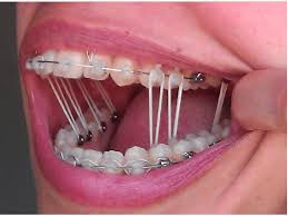See full list on wikihow.com 15 Must Knows About Braces For Potential Metalmouths To Survive The Next Two Years