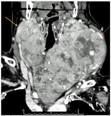 This condition, which is typically caused by mutations in the pten gene, leads to increased thyroid problems, benign growths, and a. Thyroid Nodule Symptoms