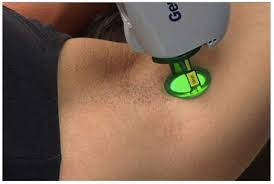 underarm laser hair removal houston