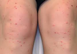 Local surgical excision is almost always curative for verruciform xanthoma. Xanthomas Plastic Surgery Key