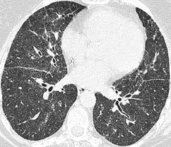 Kawakami k, minou k, hara h, sugiyama s, kitagawa m, misaki t. Pulmonary Sarcoidosis Typical And Atypical Manifestations At High Resolution Ct With Pathologic Correlation Radiographics
