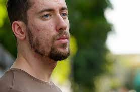 Just apply it to the areas that need to be treated, after 2.5 mins do a patch test to check how long you have to keep it. When Should Men See A Dermatologist For Adult Acne Health Essentials From Cleveland Clinic