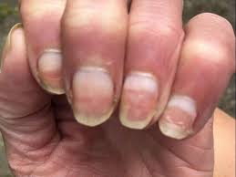 terry s nails causes diffeial