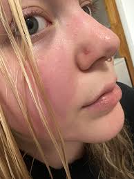 How do I get rid of this ugly bump? I'm ready to change my nose ring but  idk if I should wait until this is gone