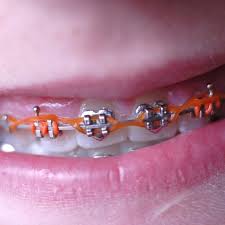Check spelling or type a new query. Braces And Power Chains Orthodontic Associates
