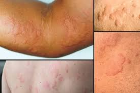 Image result for allergy rash on the legs