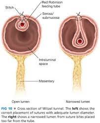 Steps in the procedure of jejunostomy 1. Feeding Jejunostomy Basicmedical Key