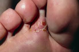 Evidently, tea leaves were once used as a folk remedy for the fungus, so why not put it to the test? Athlete S Foot Nhs