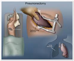 We did not find results for: Pneumonectomy Surgery For Mesothelioma Defeated Lung Removed Cleverboris