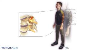 Cervical Radiculopathy Symptoms