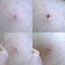 An ingrown hair near the vagina develops when the tip of a pubic hair folds back into the skin at the root. Ingrown Hair Wikipedia