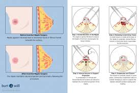 Image result for Nipple Inversion