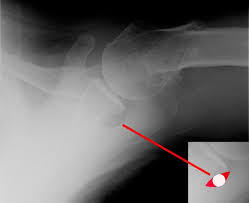 Image result for Shoulder XRay