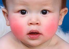 Check spelling or type a new query. Erytheme Infectieux Megalerytheme Cinquieme Maladie Sante Sur Le Net