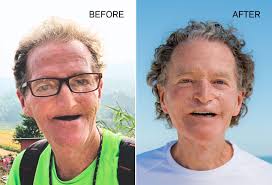 Jaw in a-Day surgery restores squamous cell carcinoma survivor's face