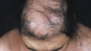 These hormones also help with hair growth. Alopecia Androgenetica In Women Altmeyers Encyclopedia Department Dermatology
