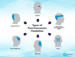 Image result for Headache