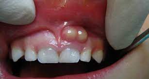 Gum Boil Gumboil In Children Gum Boils
