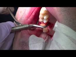 Having your natural teeth fully intact seems to be the most comfortable situation for everyone but, there are several reasons that would make your dentist decide to pull a tooth. Physics Forceps Upper Molar Tooth Extraction Cytoplast Barrier Grafting Youtube